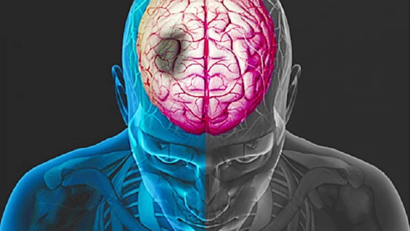 ინსულტი