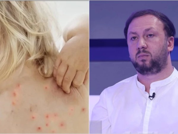 ჩუტყვავილას მკურნალობა