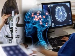 ალცჰაიმერი