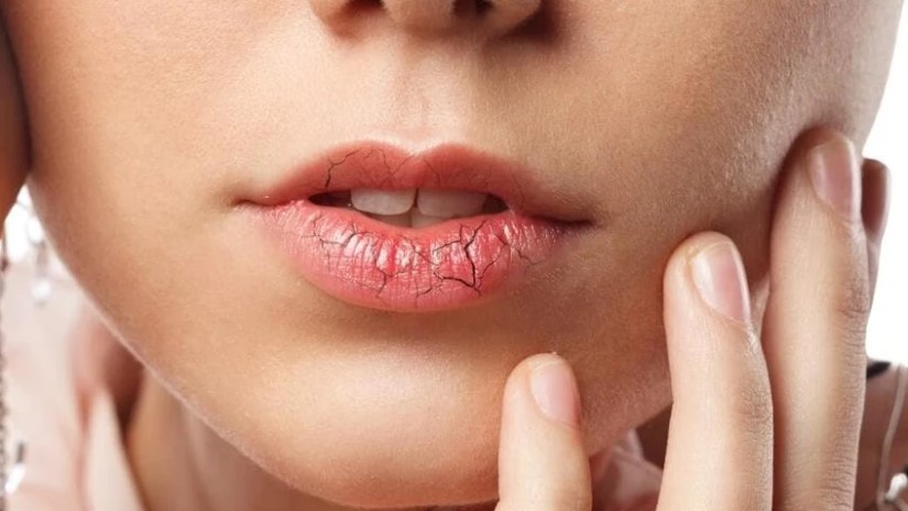 ტუჩების სიმშრალე