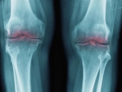 მეცნიერებმა ასაკით დაზიანებული სახსრების ხრტილები აღადგინეს