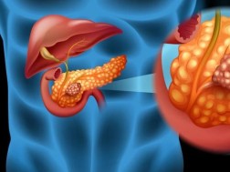 პანკრეასის კიბო