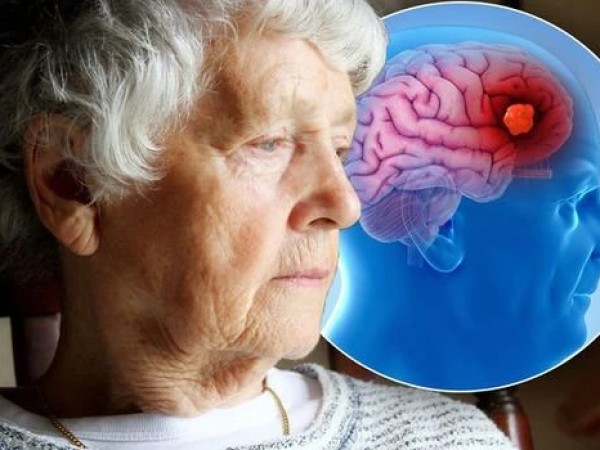 დემენცია დემენცია