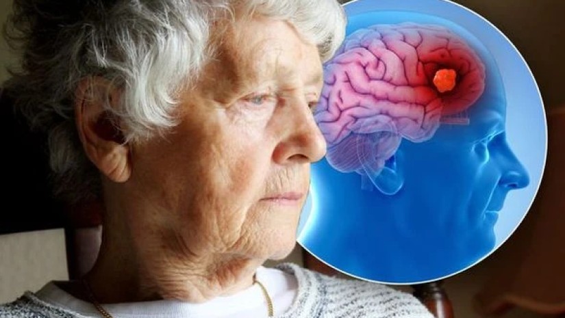 დემენცია