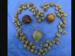 კენჭები