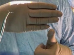 ოპერაციის დროს ბავშვს სხეულში ნემსი ჩაუტოვეს
