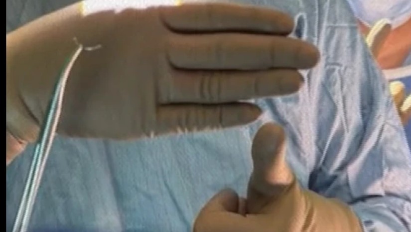 ოპერაციის დროს ბავშვს სხეულში ნემსი ჩაუტოვეს